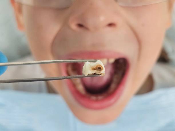 Best Dentist for Tooth Abscess  in Humboldt Hill, CA